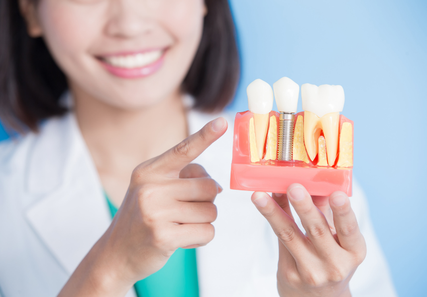 The Facts about Dental Implants